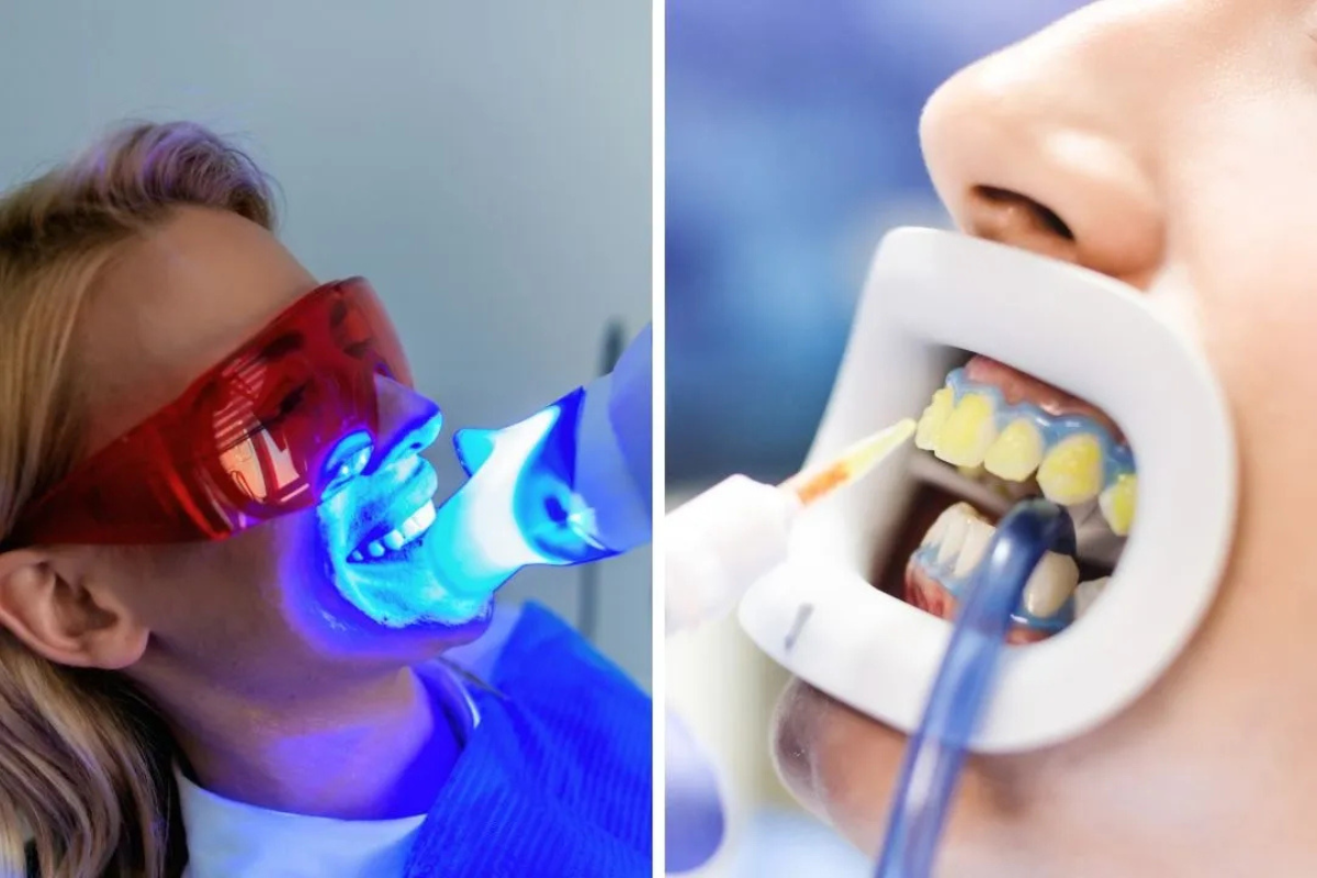 Tooth Whitening